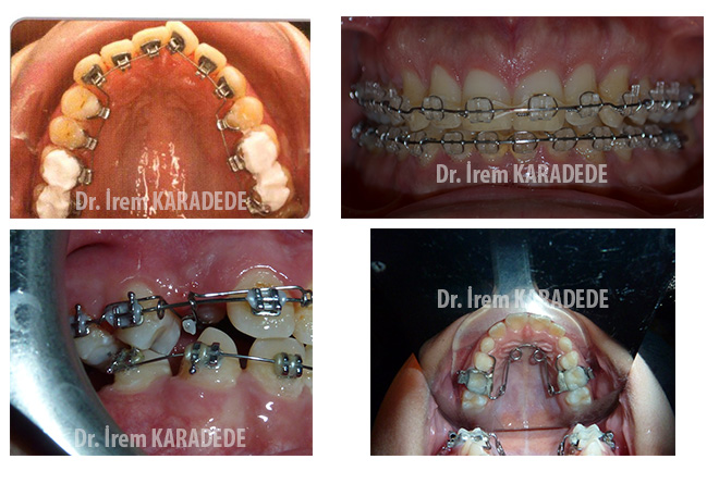 Sabit Ortodontik Aygıtlar
